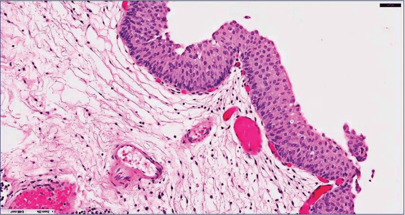 Mesane Kanseri Patoloji Raporu