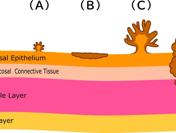 Mesane Kanseri ve Türleri