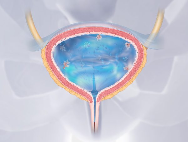 Muskularis Propria İnvazyonu