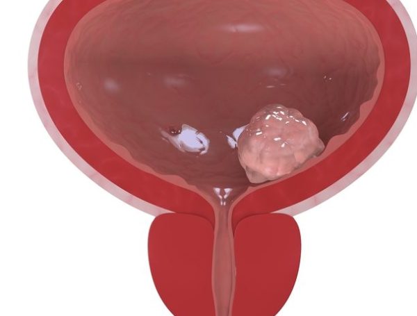 Mesane Kanseri Ameliyatı