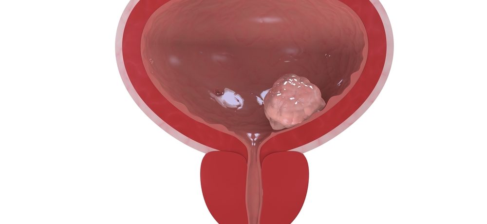 Mesane Kanseri Ameliyatı