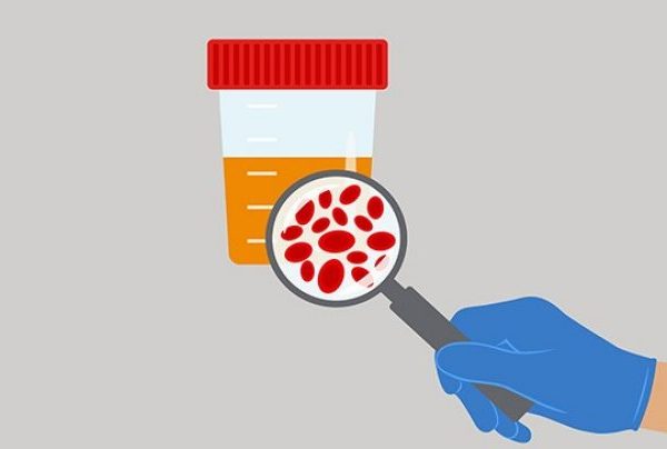 Mesane Kanserinde Erken Tanı Yöntemleri