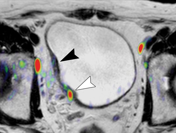 pT2 Mesane Kanseri Tedavisi