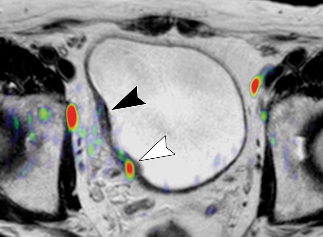 pT2 Mesane Kanseri Tedavisi