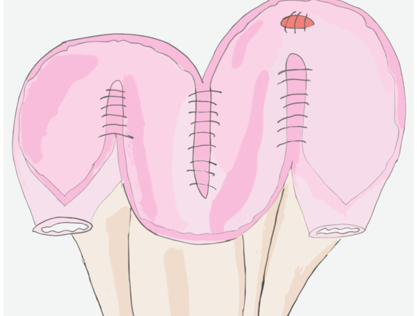 Bağırsak Mesane Nedir?