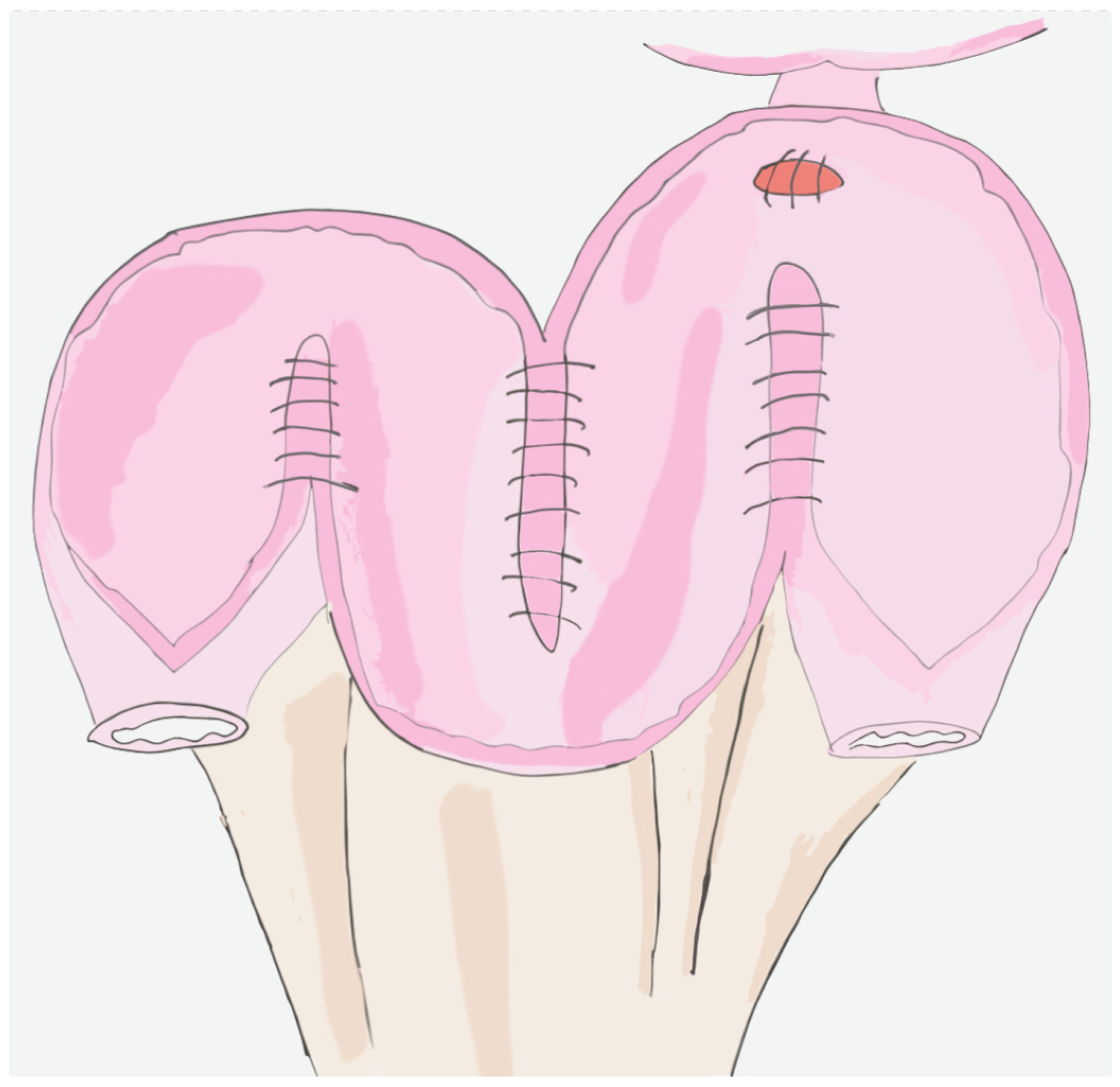 Bağırsak Mesane Nedir?