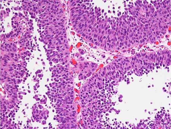 High Grade Mesane Tümörü Ne Demek?