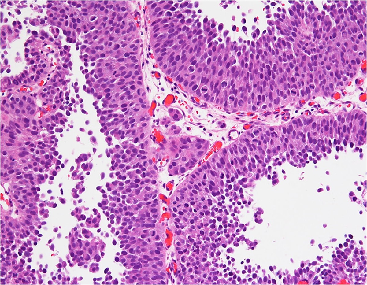 High Grade Mesane Tümörü Ne Demek?