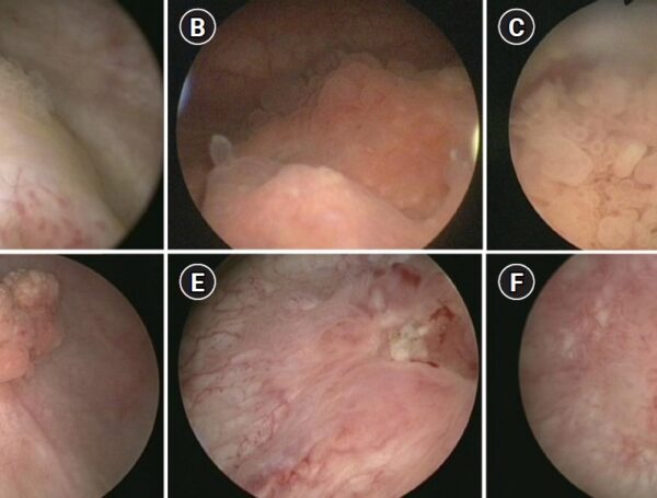 Mesane Kanseri ile Mesane Tümörü Arasındaki Fark Nedir?