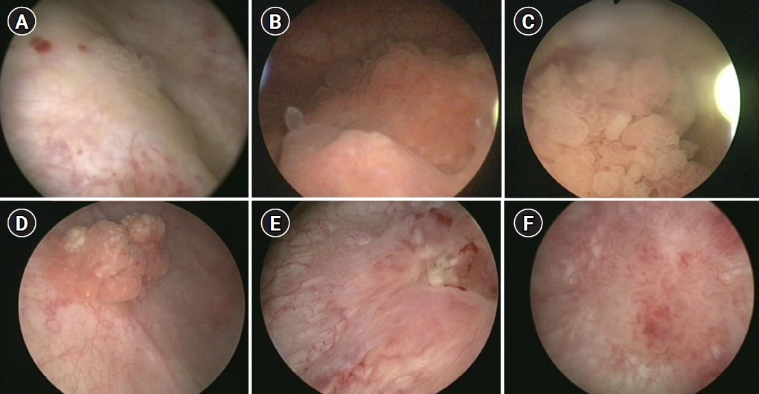 Mesane Kanseri ile Mesane Tümörü Arasındaki Fark Nedir?