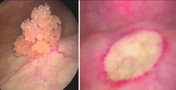 Mesanede Tümör İyi Huylu Olabilir mi?