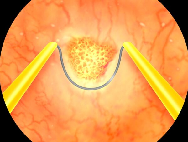 Mesane Kazıma Ameliyatı