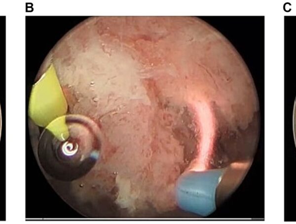 Mesane TUR Ameliyatı Kaç Kere Yapılır?