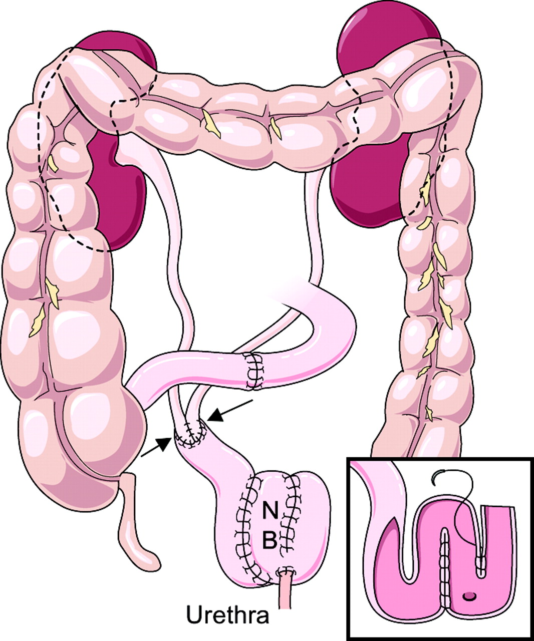 Yapay Mesane Kimler İçin Uygun Değildir?