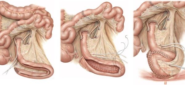 Yapay Mesane Kimler İçin Uygundur?