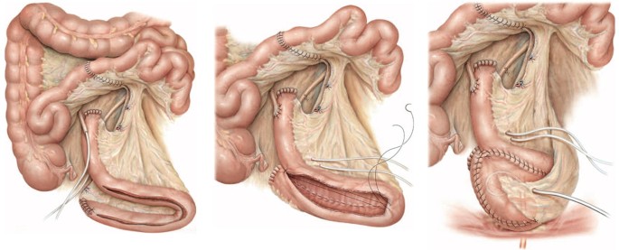 Yapay Mesane Kimler İçin Uygundur?