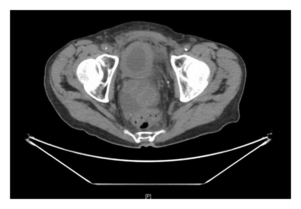 Mesane Duvarı Kalınlaşması Kanser midir?