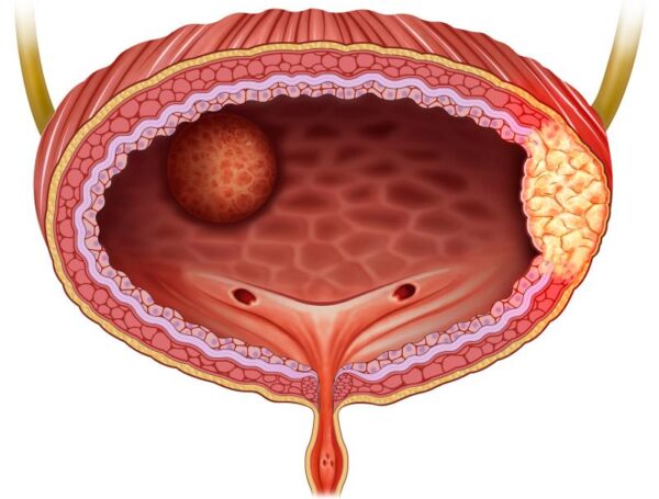 Mesane Kanserinde Mesane İçi İlaç Tedavisi