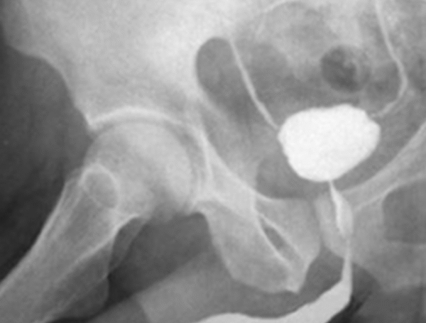 Yapay Mesane Nasıl Çalışır?