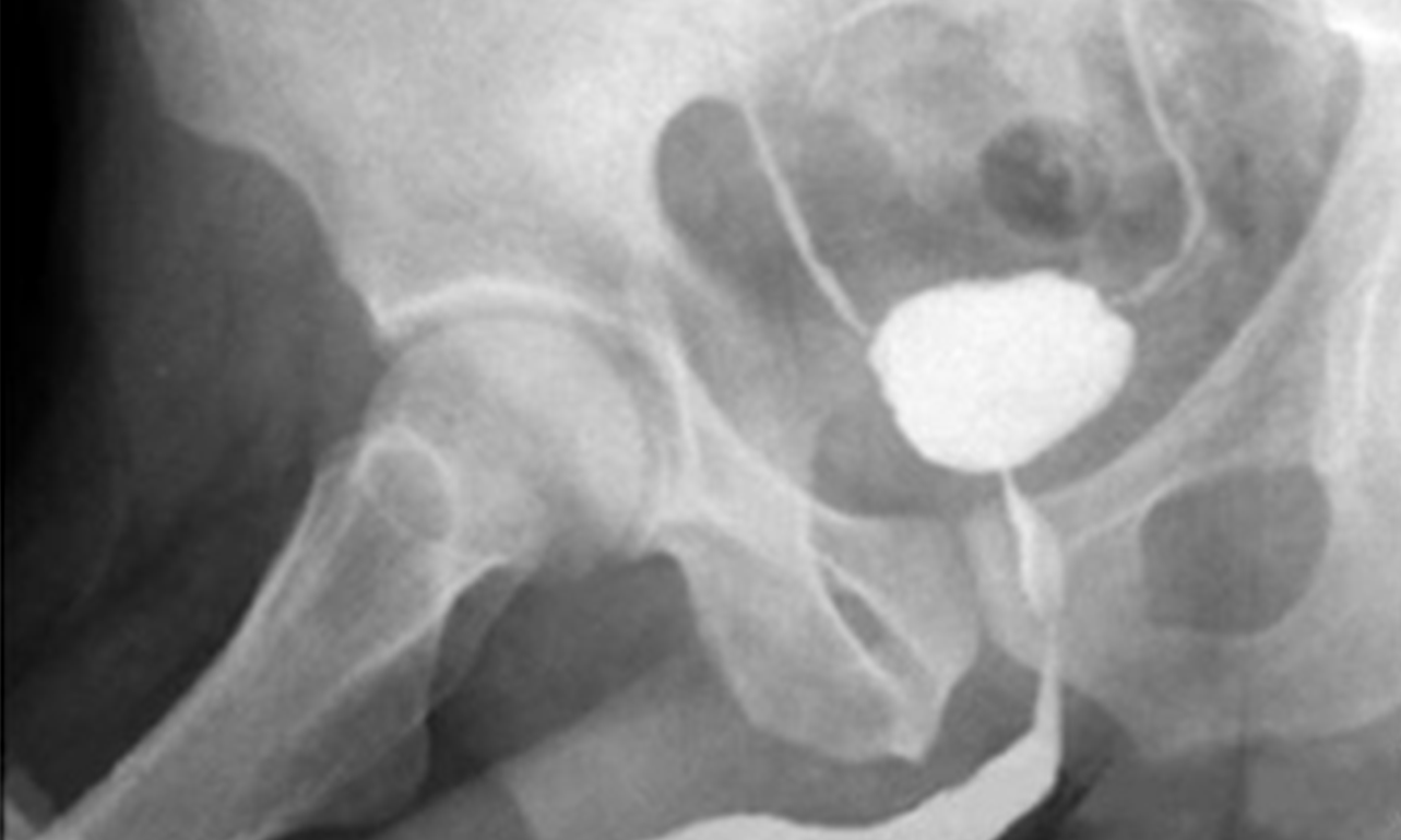 Yapay Mesane Nasıl Çalışır?